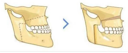 正頜手術(shù)操作示意圖