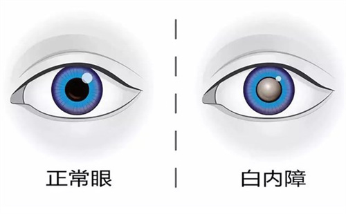 白內(nèi)障手術免費政策2025新版:光明行動新政策中符合條件老人可申請免費白內(nèi)障手術!