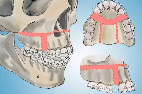 正頜手術(shù)卡通展示圖