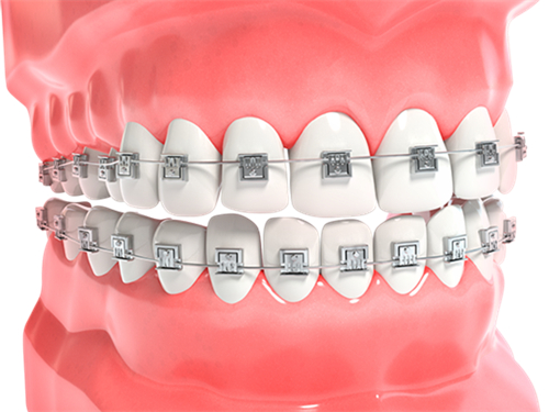 牙齒矯正金屬牙套漫畫圖