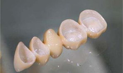 全瓷牙內(nèi)冠展示圖