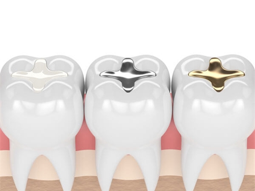 不同補牙材料成效漫畫圖