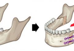 廣州正頜手術(shù)醫(yī)生周會喜簡介：20年經(jīng)驗，技術(shù)很出色！