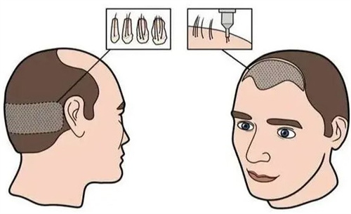 發(fā)際線植發(fā)