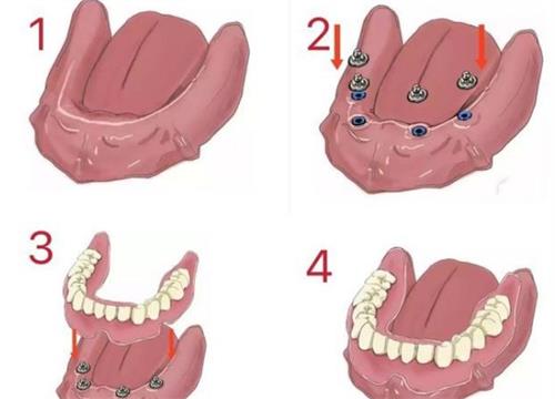BPS吸附性義齒是啥材料做的？bps吸附性義齒詳細(xì)介紹及優(yōu)缺點(diǎn)詳解！
