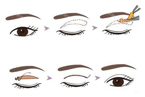 切開(kāi)法眼部整形示意圖