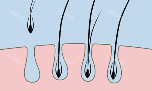 單毛囊植發(fā)展示