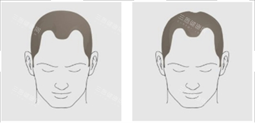 發(fā)際線后移類型