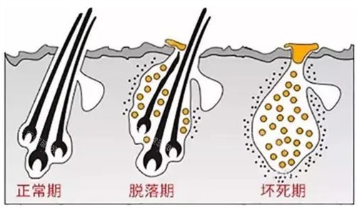 頭發(fā)生長周期圖解