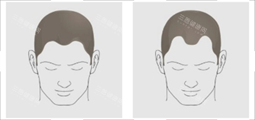 發(fā)際線對比