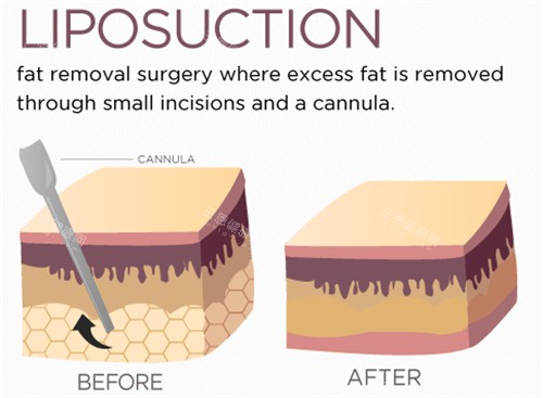 吸脂手術前后動畫對比