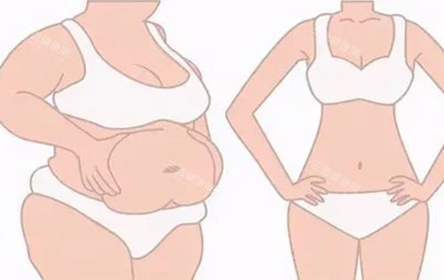 全身吸脂前后對(duì)比示意圖