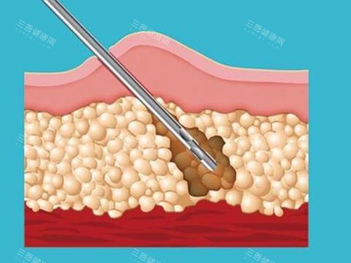 吸脂針圖片
