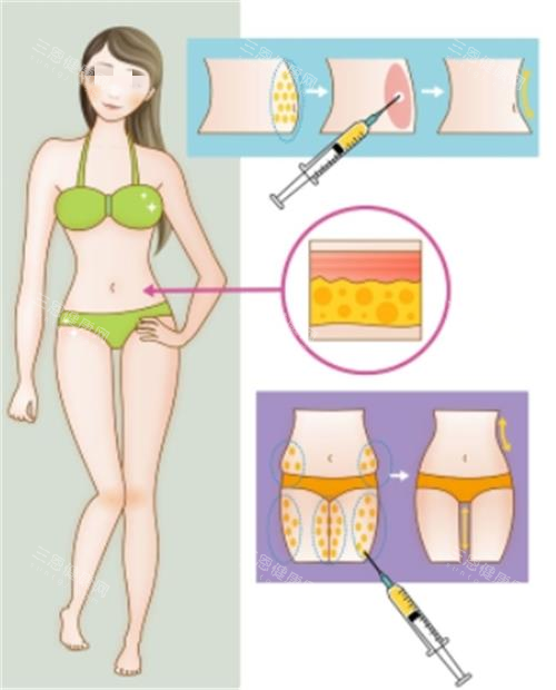 全身吸脂部位示意圖
