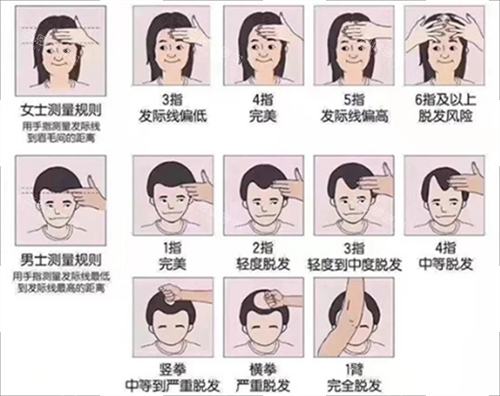 發(fā)際線測量規(guī)范