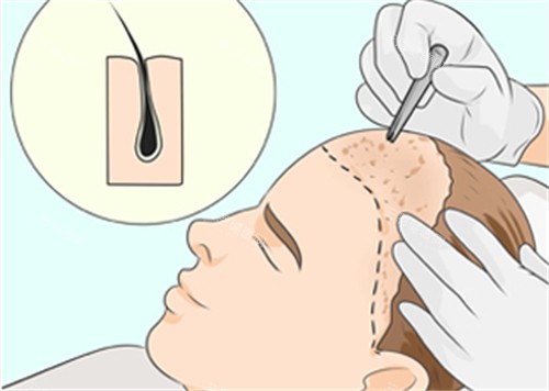 微針植發(fā)過程圖解