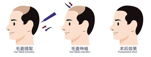 毛囊移植術前術后成效動畫圖