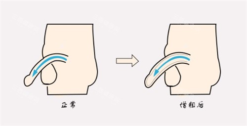 增粗術(shù)前后對比