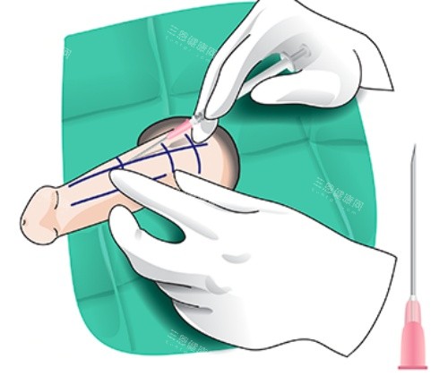 玻尿酸增粗漫畫示意圖