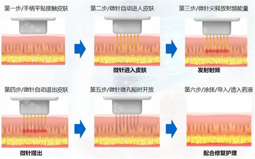 微針操作流程圖解