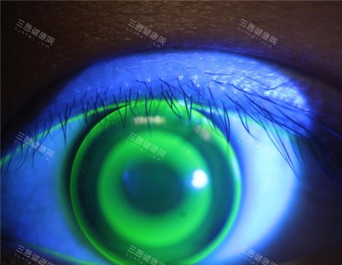 角膜塑形鏡佩戴照片