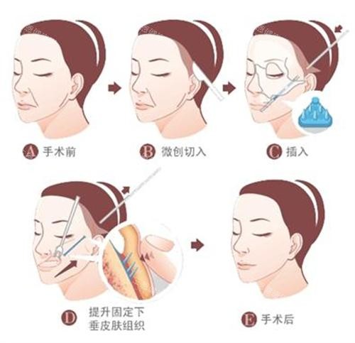 拉皮手術過程圖