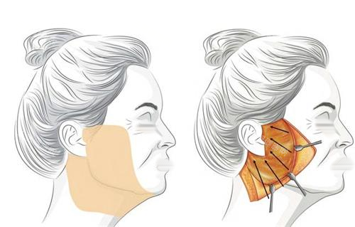 拉皮手術脂肪剝離示意圖