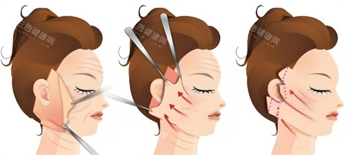 拉皮手術過程圖