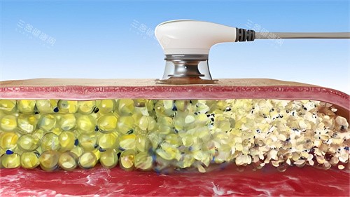 超聲波溶脂過程演示圖