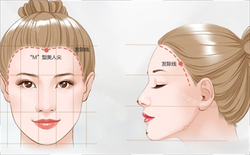M型發(fā)際線素材 M型發(fā)際線素材