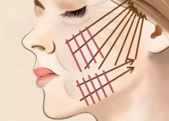 面部埋線提升