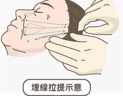 埋線提升面部的操作過程