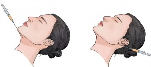 雙下巴注射