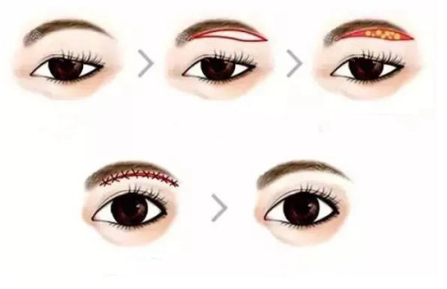 提眉手術流程示意圖