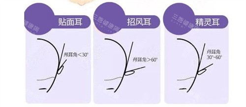 貼面耳招風(fēng)耳精靈耳區(qū)別