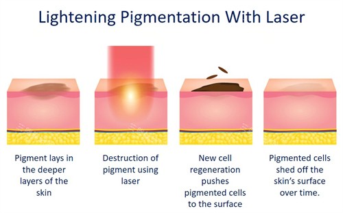激光祛斑如何改善皮膚斑點(diǎn)