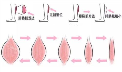 瘦腿注射前后對比