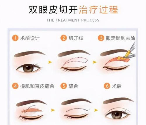雙眼皮手術(shù)方法過程圖