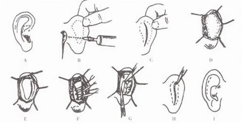 耳朵矯正手術