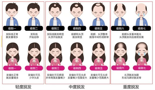 不同程度的脂溢性脫發(fā)