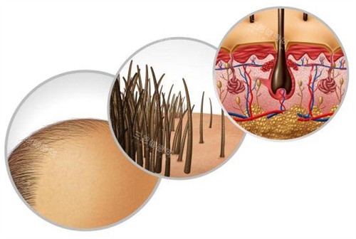 脂溢性脫發(fā)造成的問題