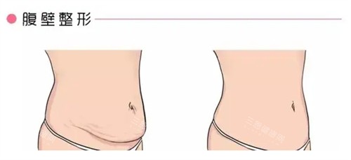 腹壁成形術前后對比圖