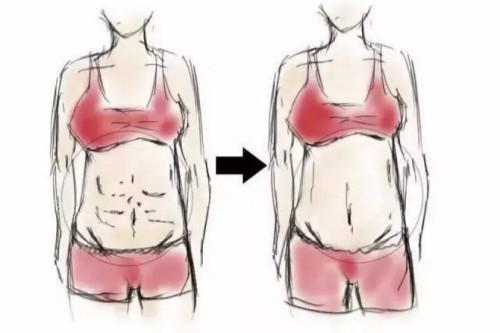 腹壁成型術卡通對比圖