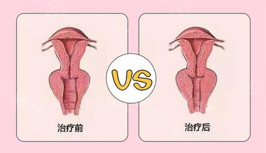 陰道緊縮針前后對比