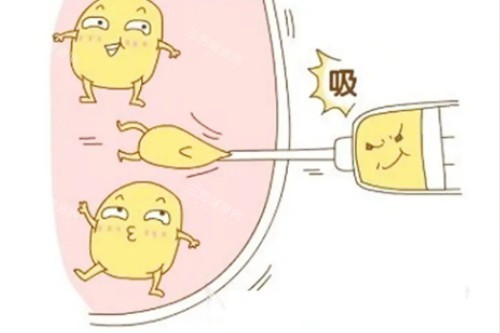 無(wú)錫麗都陳光平吸脂結(jié)果如何？術(shù)后修復(fù)過(guò)程全記錄，看完你就知道值不值得做！