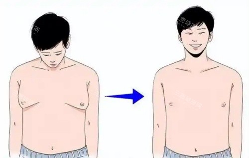 男性乳房發(fā)育吸脂前后示意圖