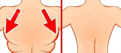 背部吸脂前后動(dòng)畫對(duì)比圖