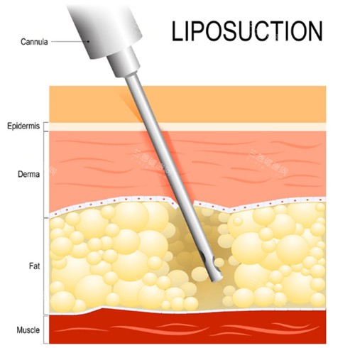 抽脂手術(shù)動(dòng)畫(huà)演示
