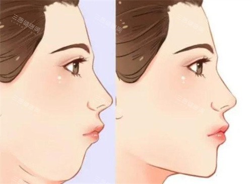 雙下巴抽脂前后對(duì)比側(cè)面動(dòng)畫(huà)圖