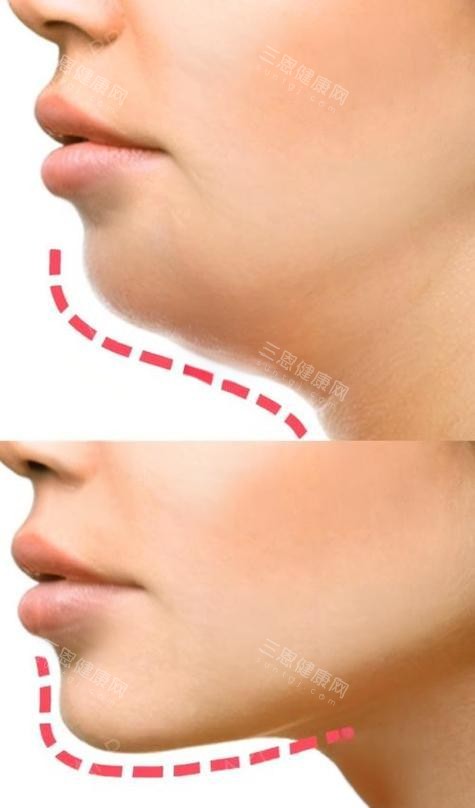 雙下巴抽脂前后對(duì)比側(cè)面圖